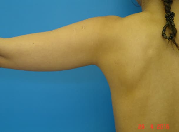 Липосакция рук - До (Анфас)