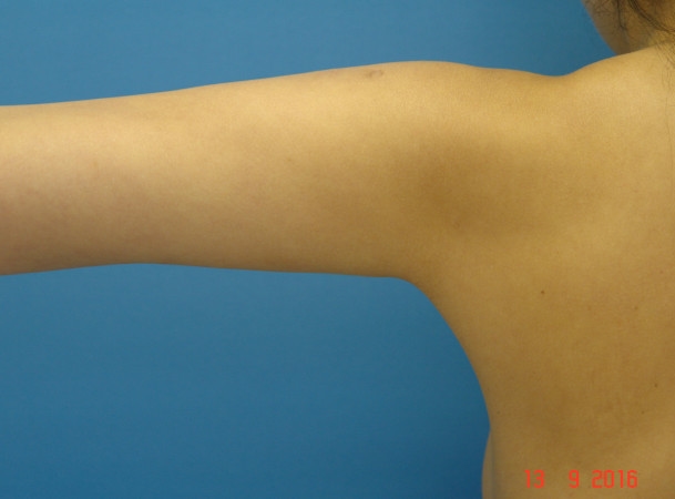 Липосакция рук - после