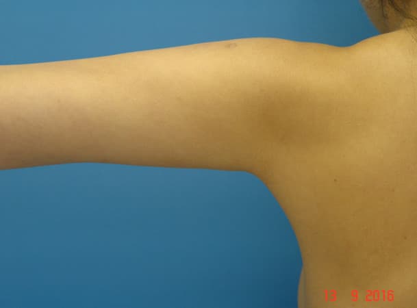 Липосакция рук - после