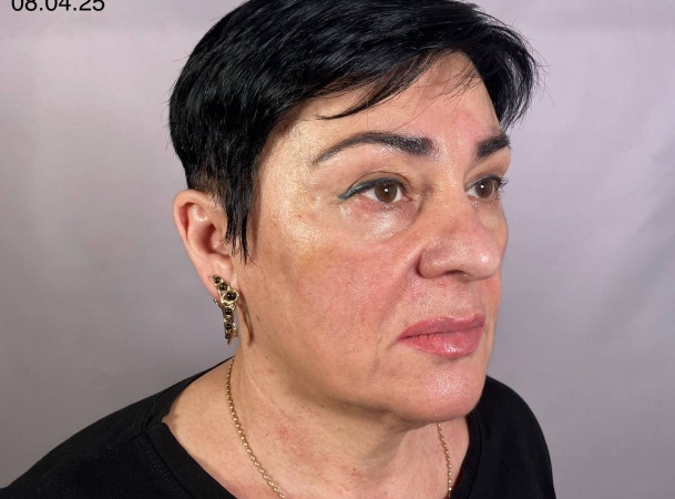 Темпоропластика, Блефаропластика нижних век, Эндоскопическая подтяжка средней зоны лица, СМАС-лифтинг, Платизмопластика - До (threeQuarterView)