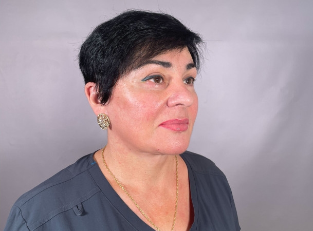 Темпоропластика, Блефаропластика нижних век, Эндоскопическая подтяжка средней зоны лица, СМАС-лифтинг, Платизмопластика - После (threeQuarterView)