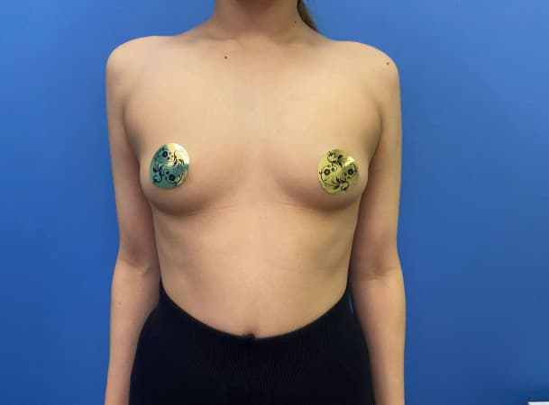 Увеличение груди - До (frontView)