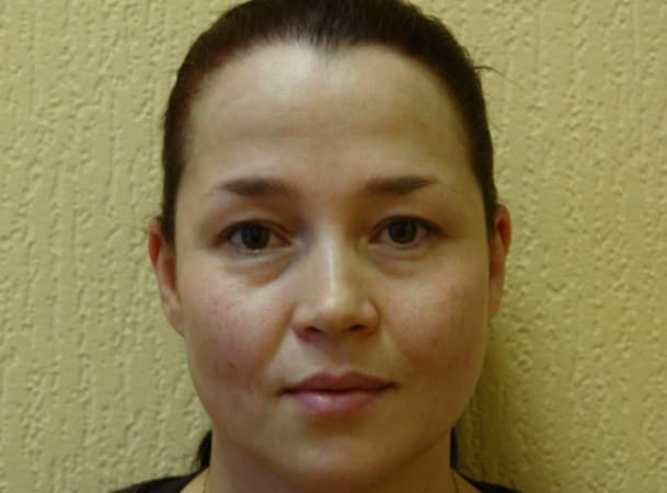 Блефаропластика верхних и нижних век - до