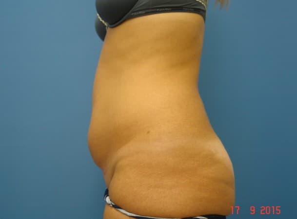 Липосакция живота - до