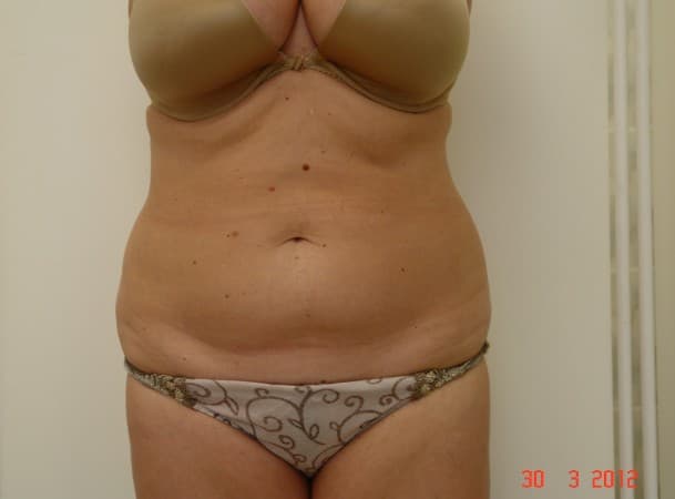 Липосакция живота - до
