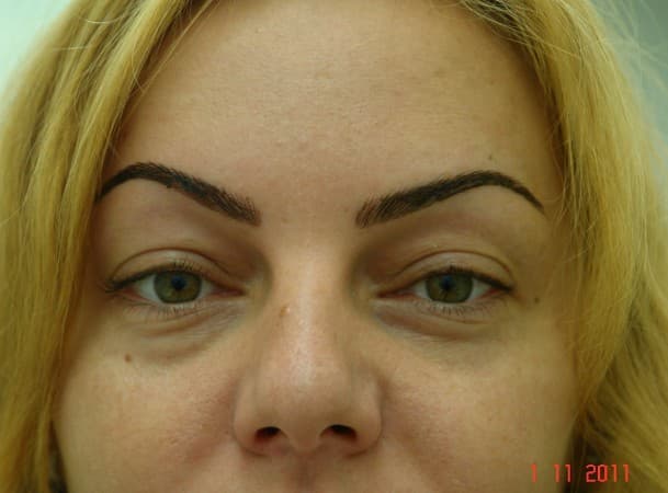 Блефаропластика верхних и нижних век - до