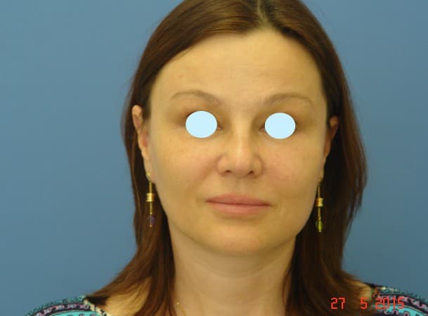 Тотальный эндоскопический лифтинг лица - после