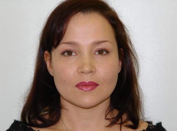 Блефаропластика верхних и нижних век - после