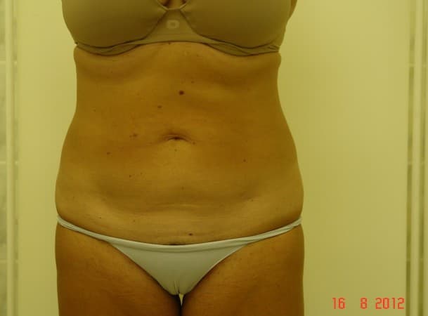 Липосакция живота - после