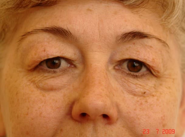 Блефаропластика верхних и нижних век - до