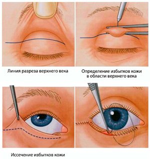 Грыжа век операция цена