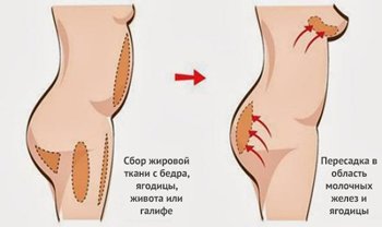 процедура липофилинга