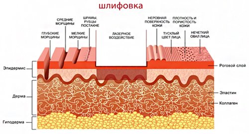 Удаление шрамов на позвоночнике