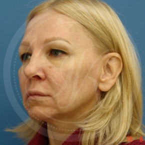 СМАС-лифтинг лица, блефаропластика верхних век, Спереди, фото До