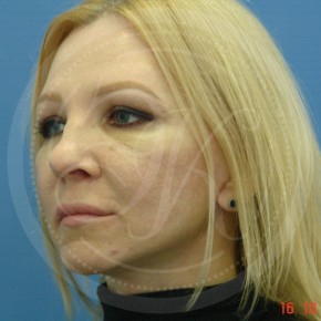 СМАС-лифтинг лица, блефаропластика верхних век, Спереди, фото После