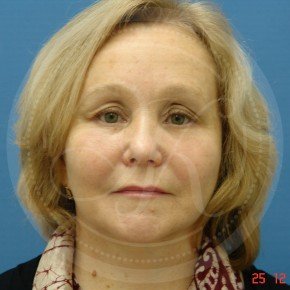 Тотальный лифтинг лица: эндоскопия лба, средней зоны лица, блефаропластика нижних век, СМАС-лифтинг лица, платизмопластика, Спереди, фото После