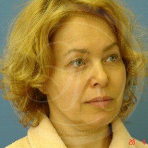 Тотальный лифтинг лица, Три четверти, фото До