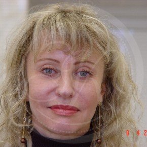 Эндоскопия лба, средней зоны лица, блефаропластика нижних век, Спереди, фото После