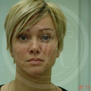 Эндоскопический лифтинг лба, эндоскопический лифтинг средней зоны лица, блефаропластика нижних век, Спереди, фото После