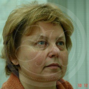 Эндоскопический лифтинг лба, блефаропластика нижних век, Три четверти, фото До