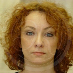 Эндоскопический лифтинг лба, блефаропластика нижних век, СМАС-лифтинг лица, Спереди, фото После