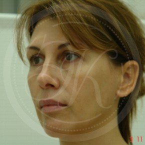 Эндоскопический лифтинг лба, средней зоны лица, блефаропластика нижних век, Три четверти, фото До