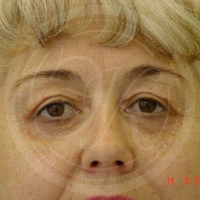 Блефаропластика верхних и нижних век, Спереди, фото После