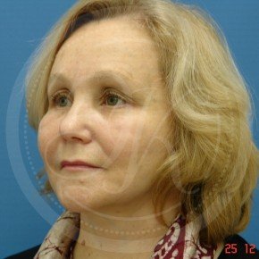 Тотальный лифтинг лица: эндоскопия лба, средней зоны лица, блефаропластика нижних век, СМАС-лифтинг лица, платизмопластика, Три четверти, фото После