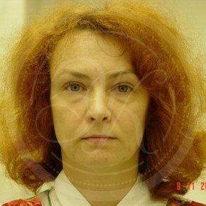 Эндоскопический лифтинг лба, блефаропластика нижних век, СМАС-лифтинг лица, Спереди, фото До