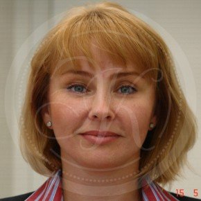 Тотальный лифтинг лица: эндоскопия лба, средней зоны лица, блефаропластика нижних век, СМАС-лифтинг лица, Спереди, фото После