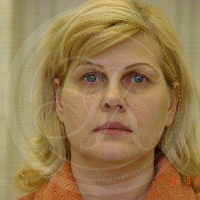 Тотальный лифтинг лица: эндоскопия лба, средней зоны лица, блефаропластика нижних век, СМАС-лифтинг лица, Спереди, фото До