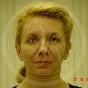 Эндоскопический лифтинг лба и средней зоны лица, Спереди, фото До