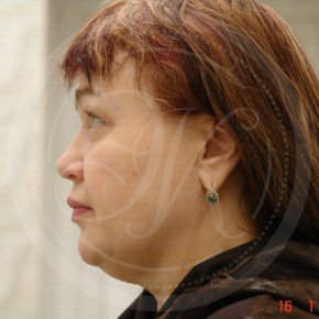 Подтяжка лица, Профиль, фото До