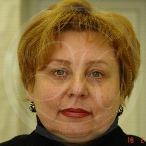 Эндоскопический лифтинг лба, блефаропластика нижних век, Спереди, фото После