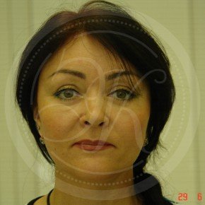 Тотальный лифтинг лица: эндоскопия лба, средней зоны лица, блефаропластика нижних век, СМАС-лифтинг лица, платизмопластика, Спереди, фото После