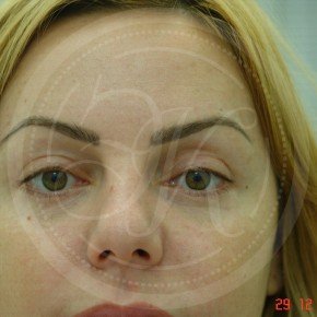 Блефаропластика верхних и нижних век, Спереди, фото После