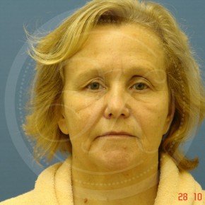 Тотальный лифтинг лица: эндоскопия лба, средней зоны лица, блефаропластика нижних век, СМАС-лифтинг лица, платизмопластика, Спереди, фото До