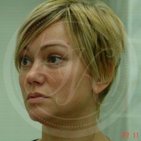 Эндоскопический лифтинг лба, эндоскопический лифтинг средней зоны лица, блефаропластика нижних век, Три четверти, фото После