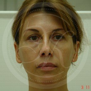 Эндоскопический лифтинг лба, средней зоны лица, блефаропластика нижних век, Спереди, фото До