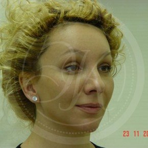 Эндоскопический лифтинг лба и средней зоны лица, Три четверти, фото После
