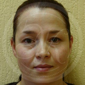 Блефаропластика верхних и нижних век, Спереди, фото До