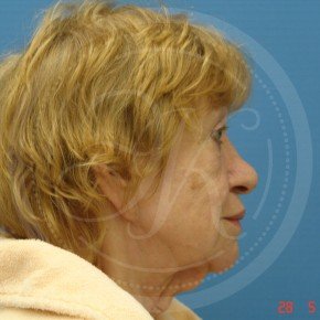 СМАС-лифтинг лица, Платизмопластика, Профиль, фото До