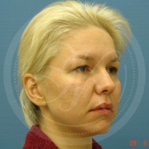 Эндоскопический лифтинг лба, Три четверти, фото До