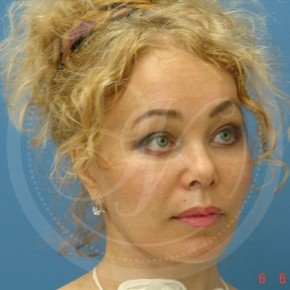 Тотальный лифтинг лица, Три четверти, фото После