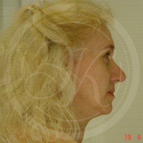 СМАС-лифтинг лица, Платизмопластика, Профиль, фото До