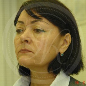 Тотальный лифтинг лица: эндоскопия лба, средней зоны лица, блефаропластика нижних век, СМАС-лифтинг лица, платизмопластика, Три четверти, фото До