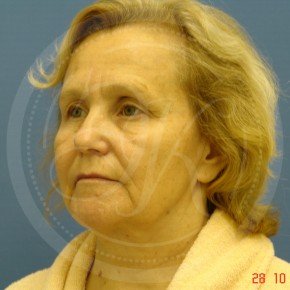 Тотальный лифтинг лица: эндоскопия лба, средней зоны лица, блефаропластика нижних век, СМАС-лифтинг лица, платизмопластика, Три четверти, фото До