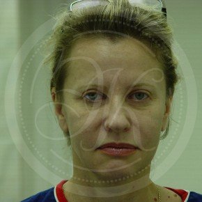 Эндоскопия лба, средней зоны лица, блефаропластика нижних век, Спереди, фото До