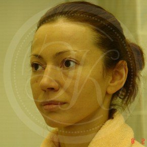 Эндоскопический лифтинг лба, средней зоны лица, блефаропластика нижних век, Спереди, фото До