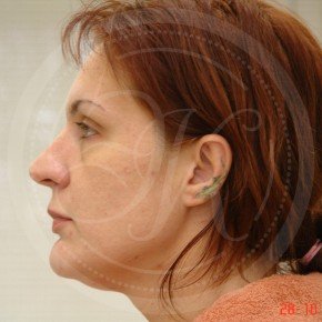 Эндоскопический лифтинг лба, средней зоны лица, блефаропластика нижних век, Профиль, фото До